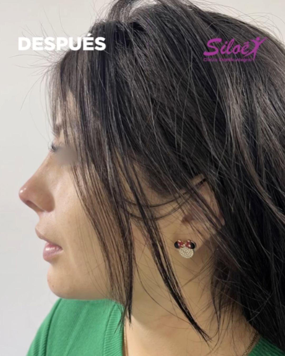 Después del tratamiento de ácido hialurónico