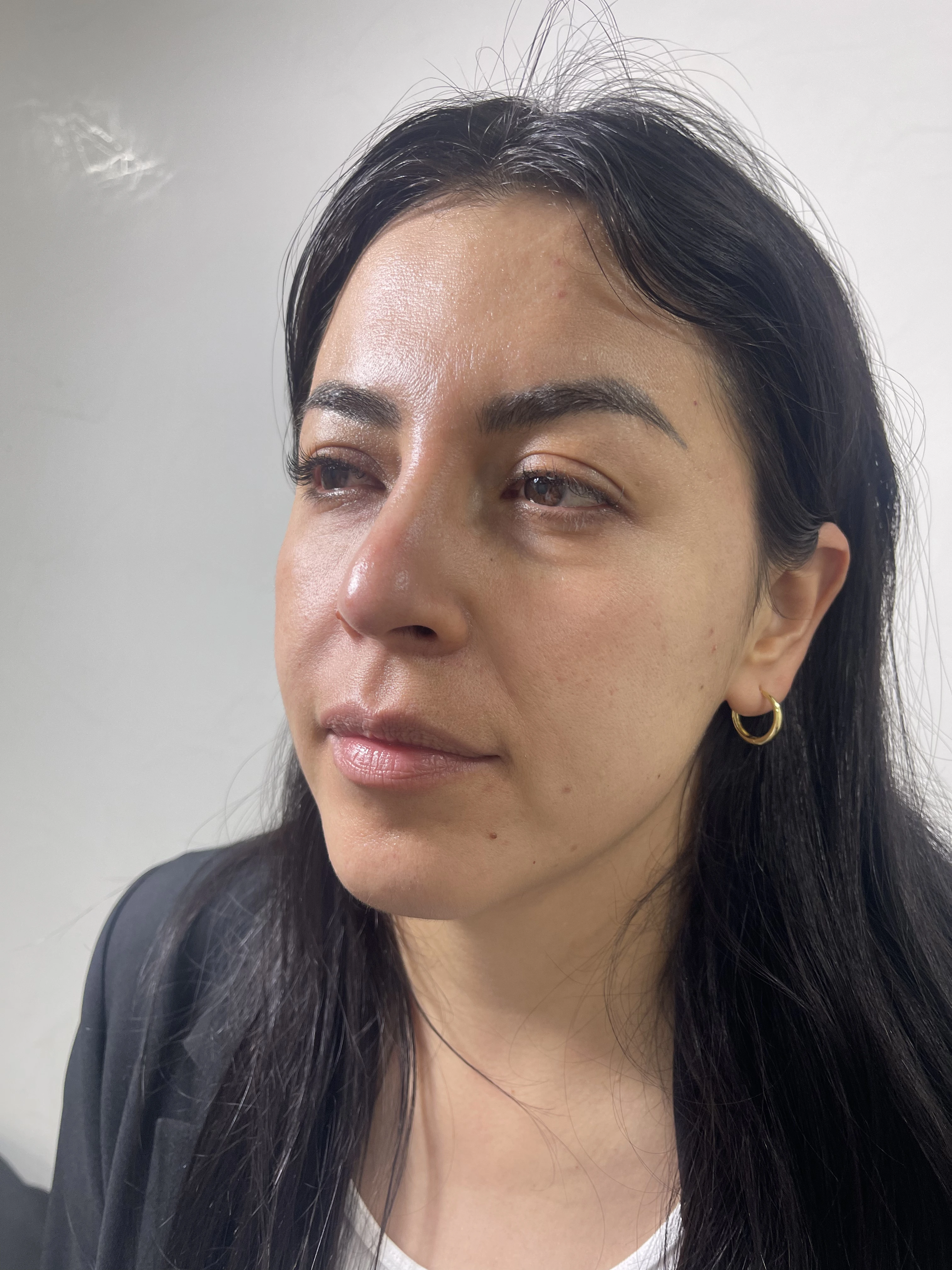 Antes del tratamiento de bioestimuladores