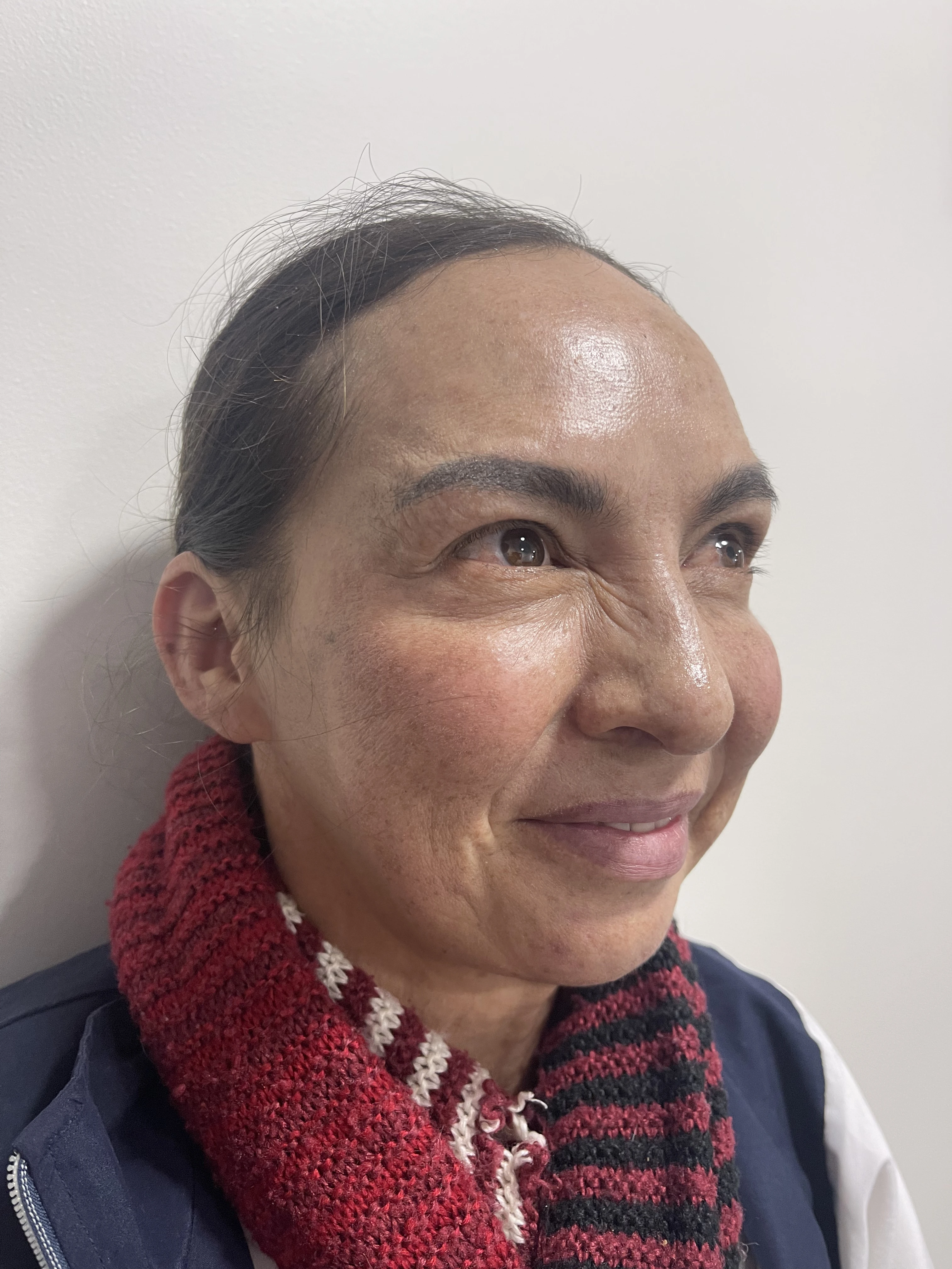 Después del tratamiento de Botox