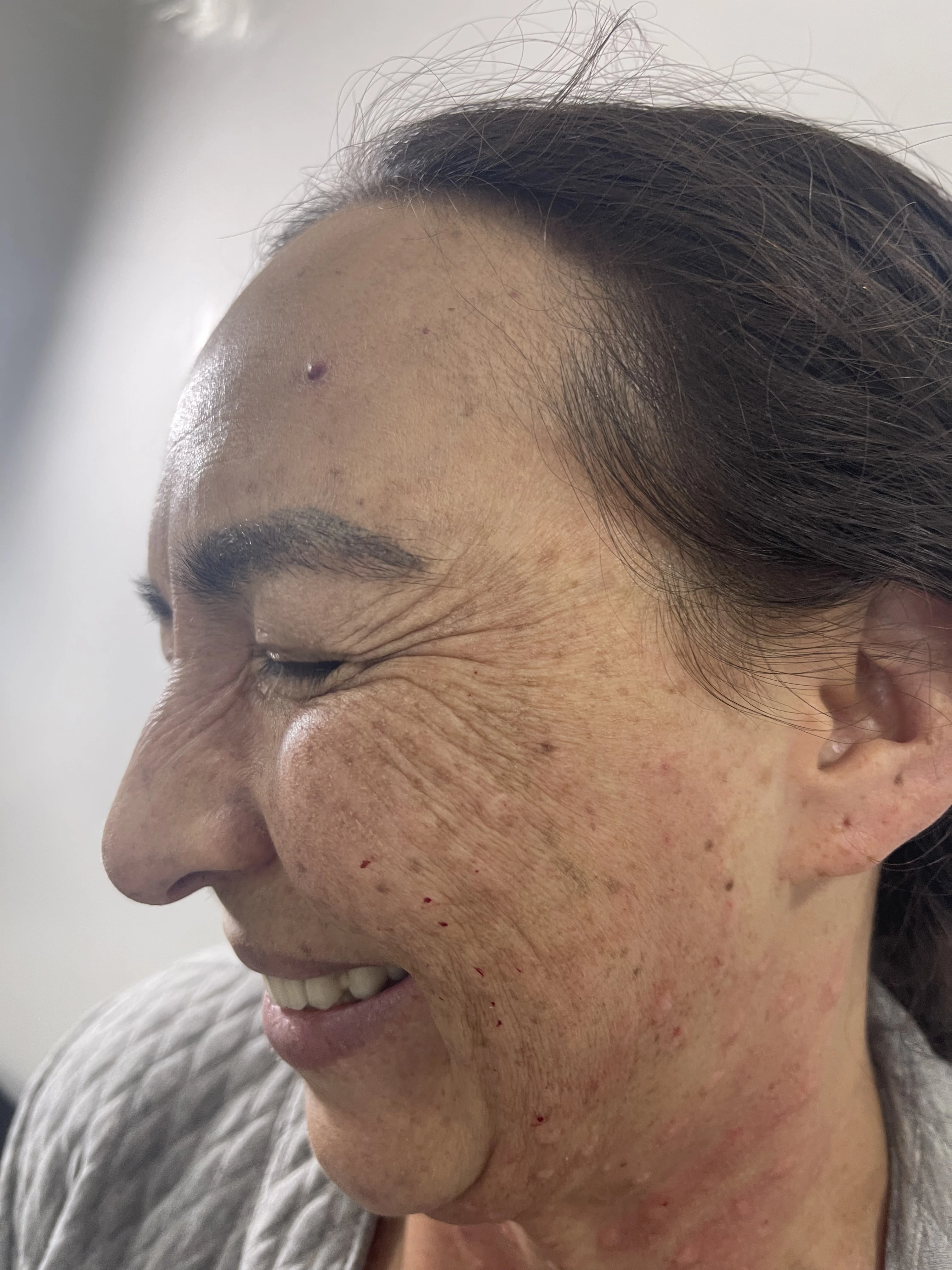 Antes del tratamiento de Botox