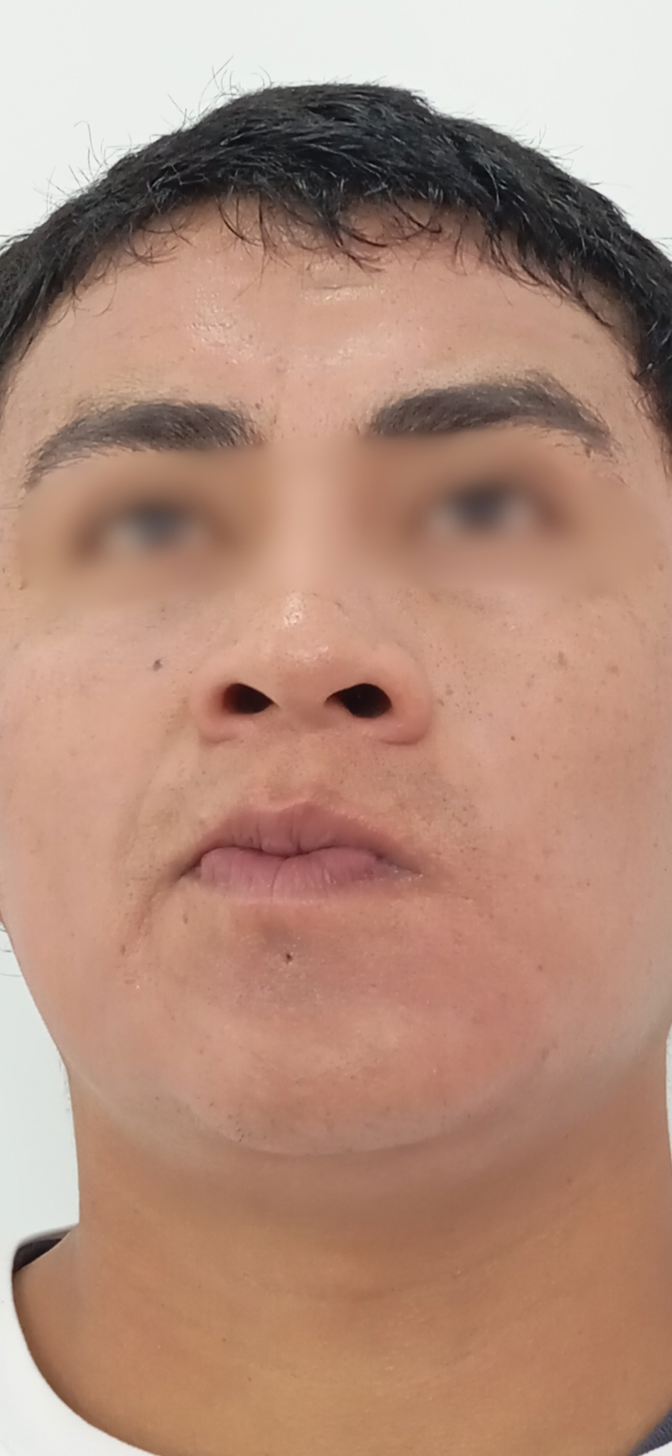 Después del tratamiento Láser CO2