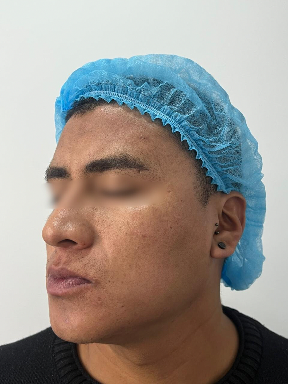 Antes del tratamiento Láser CO2