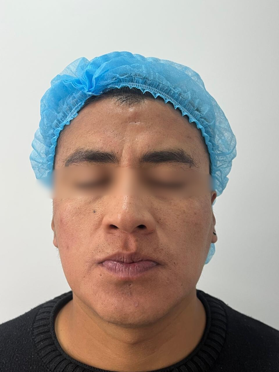 Antes del tratamiento Láser CO2