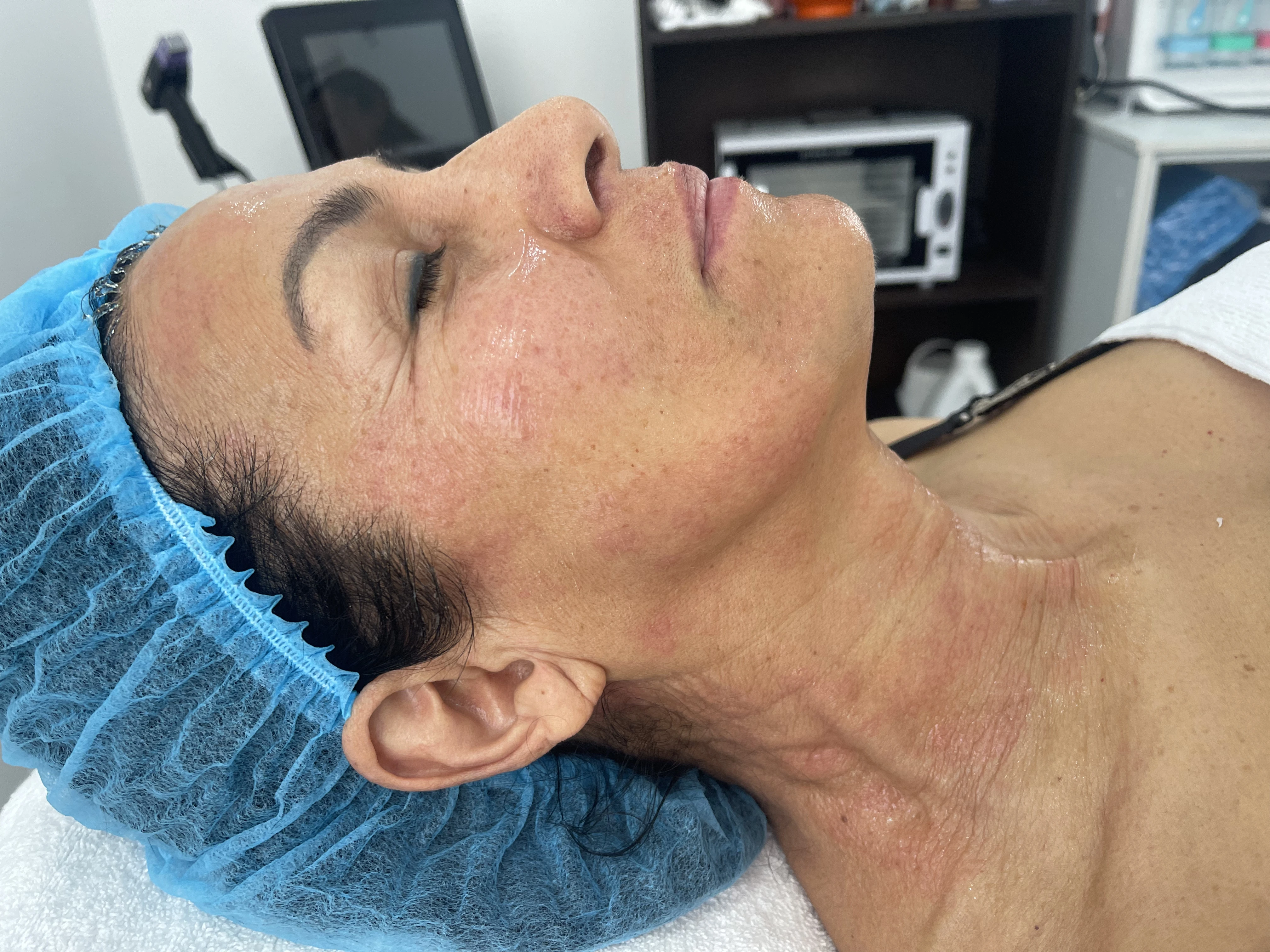 Después del tratamiento Morpheus Facial