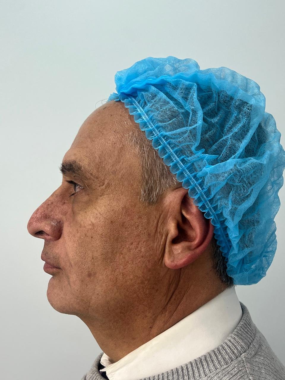 Después del tratamiento Pico Láser