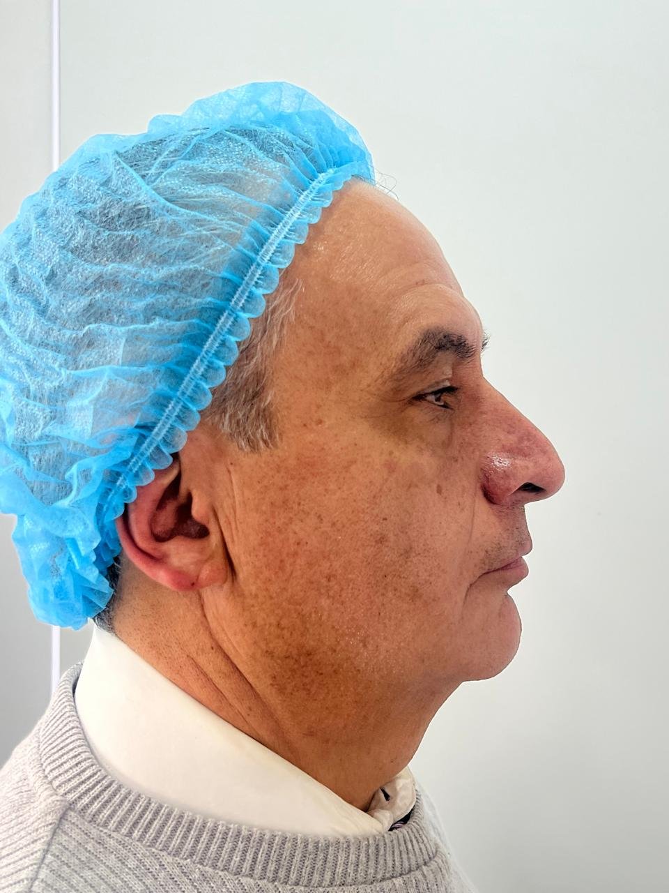 Después del tratamiento Pico Láser