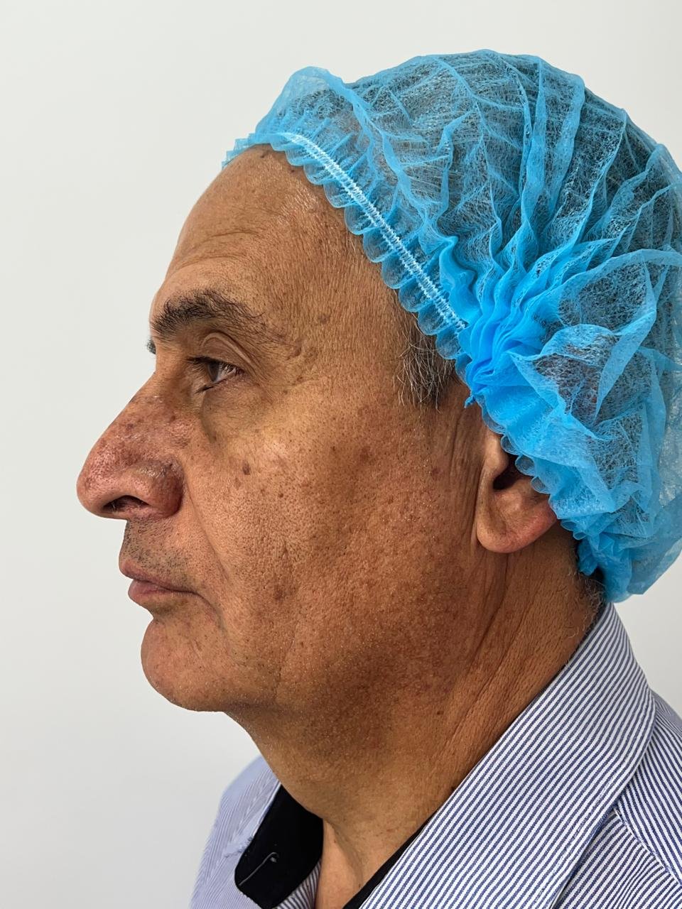 Antes del tratamiento Pico Láser