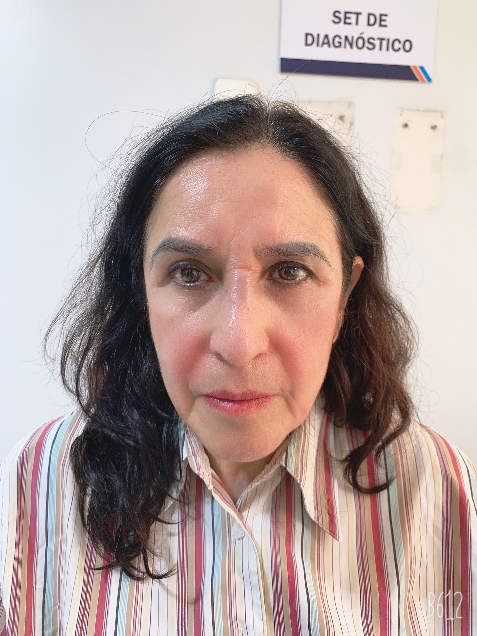 Después del tratamiento Skin Booster