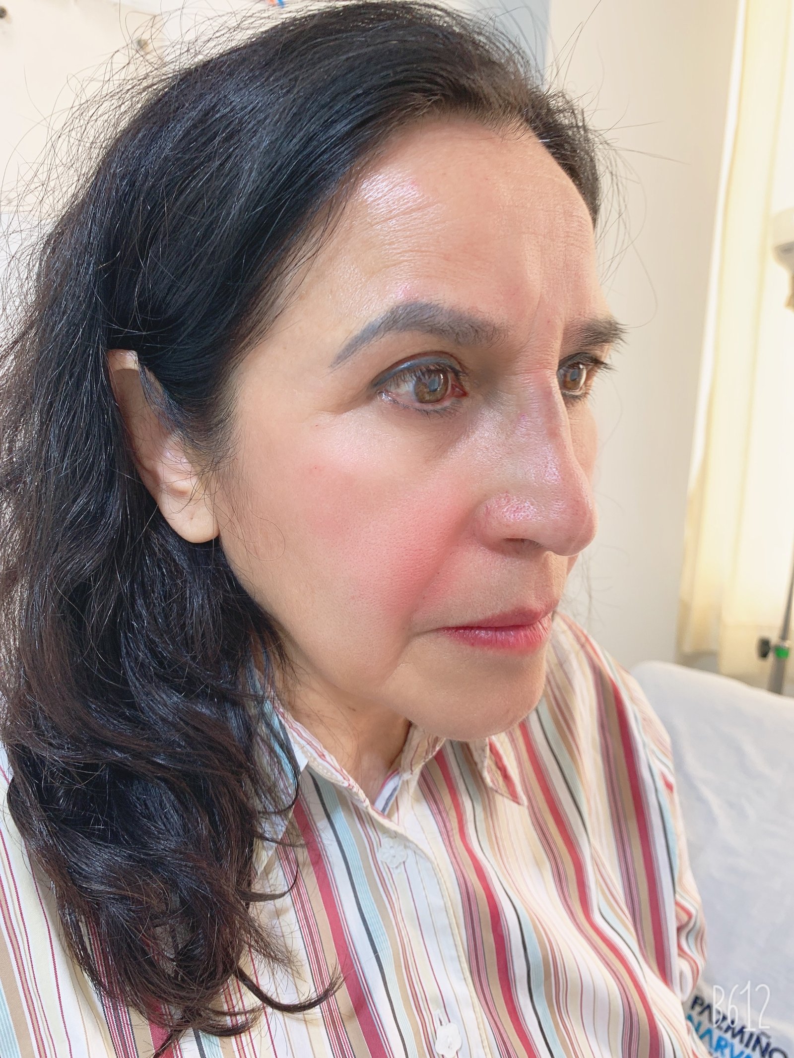 Después del tratamiento Skin Booster